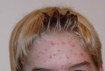 Akne im Gesicht